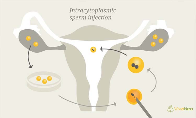 What is Intracytoplasmic sperm injection (ICSI) fertility treatment