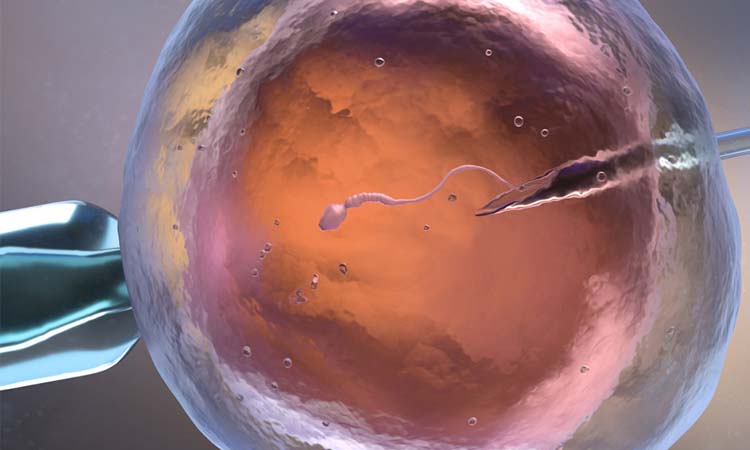 IVF Cost for Iraqi Patients
