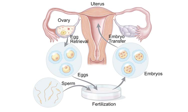IVF Cost in Ahmednagar: Test Tube Baby Cost in Ahmednagar, Low-cost IVF Centres in Ahmednagar