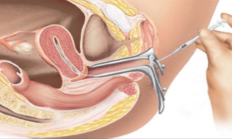 IUI Cost in Delhi: Low-Cost IUI Centres in Delhi
