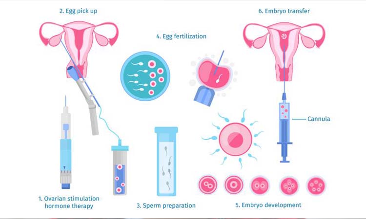 IVF Cost in Hosur: Test Tube Baby Cost in Hosur, Low-cost IVF Centres in Hosur