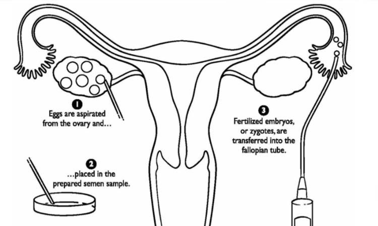 IVF Cost in Kumbakonam: Test Tube Baby Cost in Kumbakonam, Low-cost IVF Centres in Kumbakonam