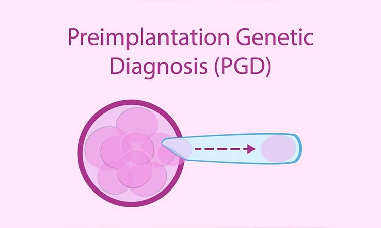 Preimplantation Genetic Diagnosis (PGD)
