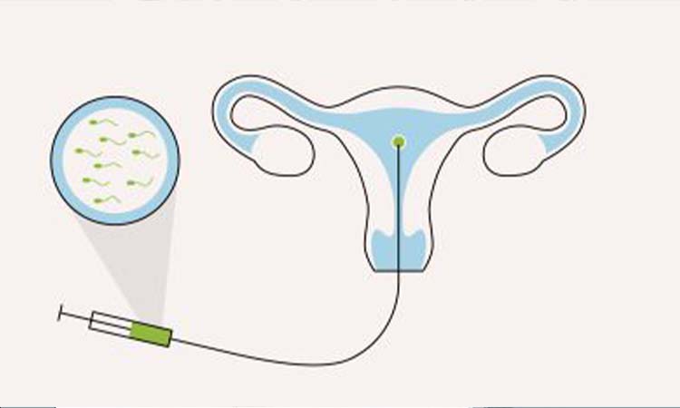 IVF Cost in Palghar: Test Tube Baby Cost in Palghar, Low-cost IVF Centres in Palghar