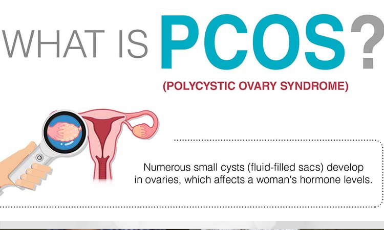 Polycystic Ovary Syndrome (PCOS): Symptoms, Causes and Cure